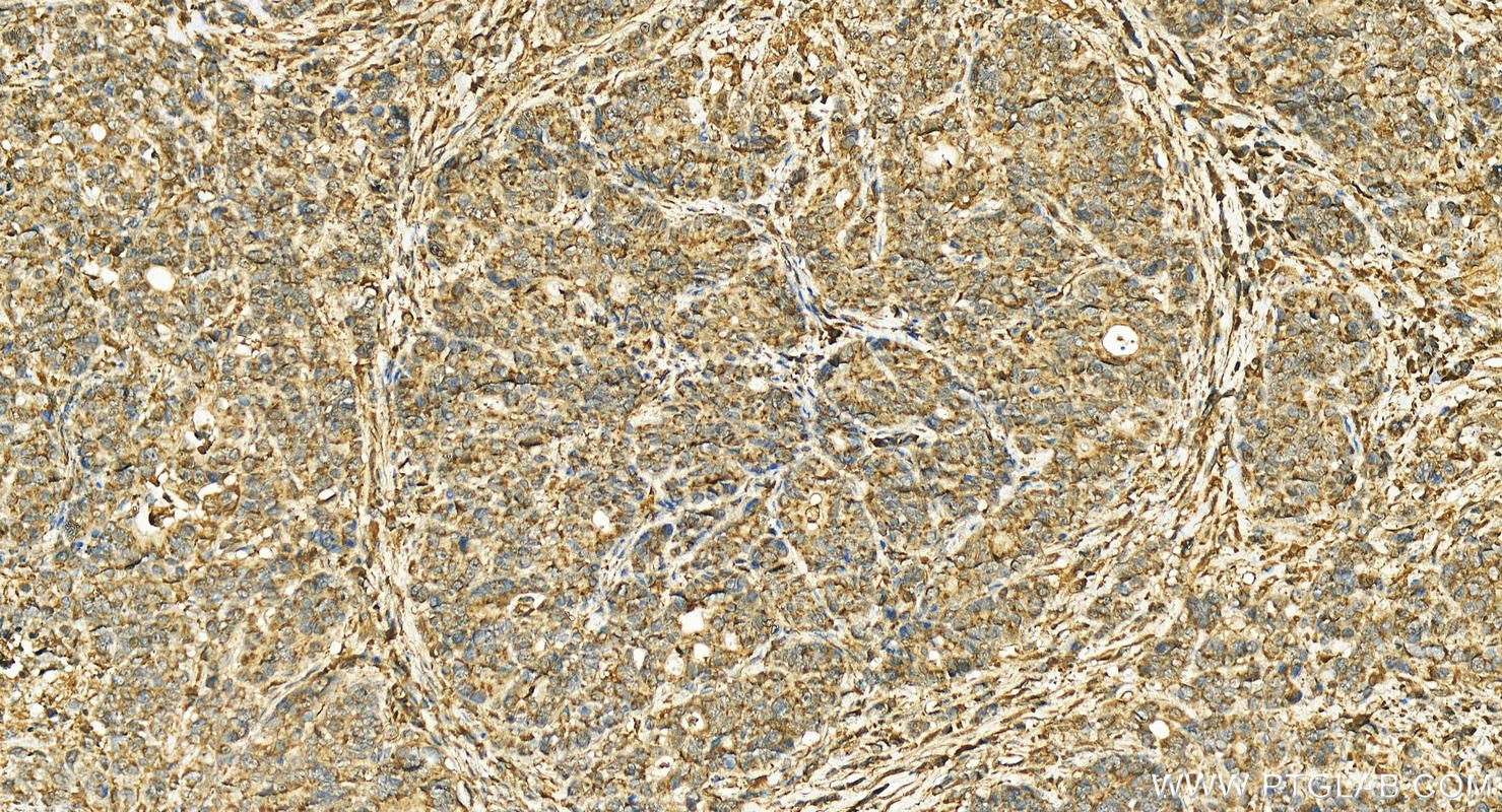 IHC staining of human stomach cancer using 10446-1-AP