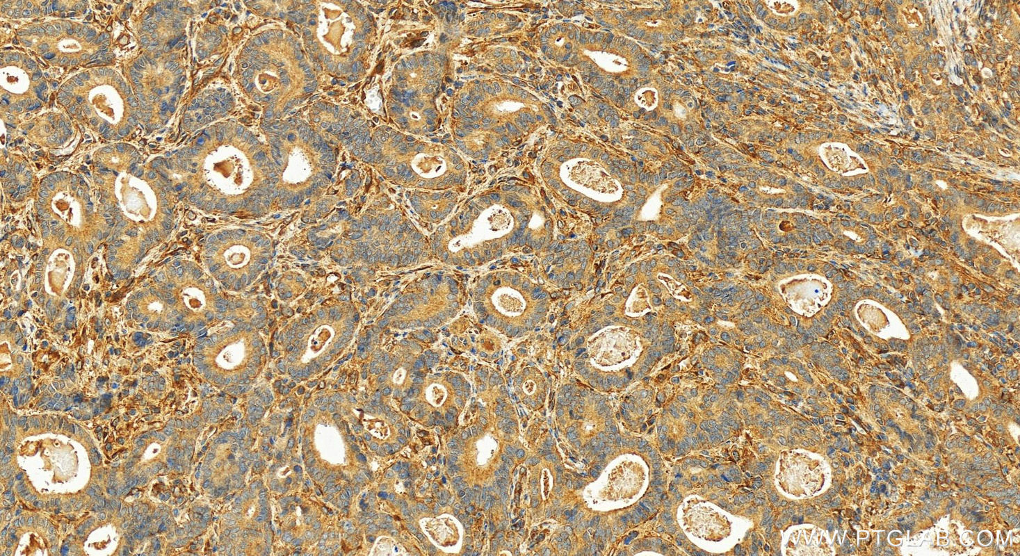 IHC staining of human stomach cancer using 13766-1-AP