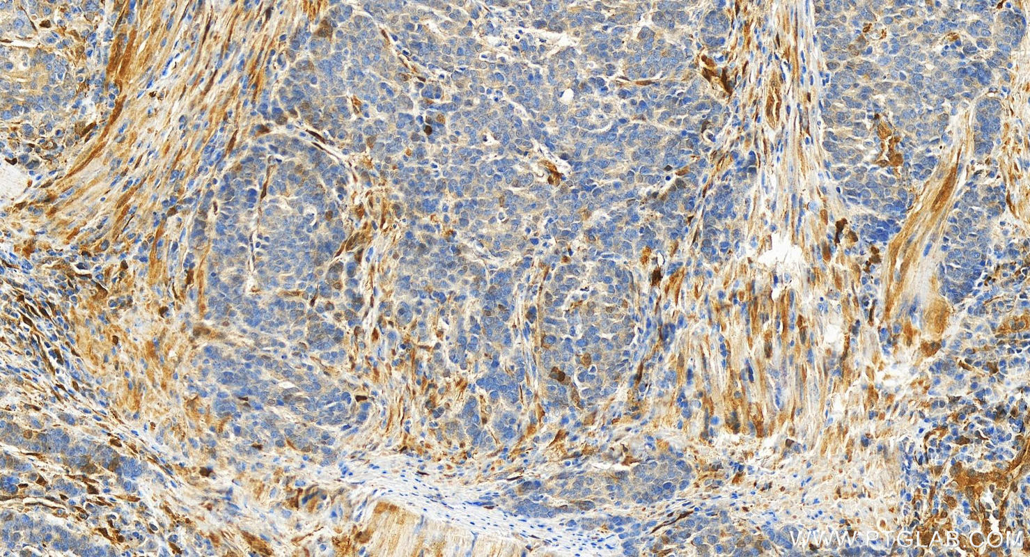 IHC staining of human stomach cancer using 15123-1-AP