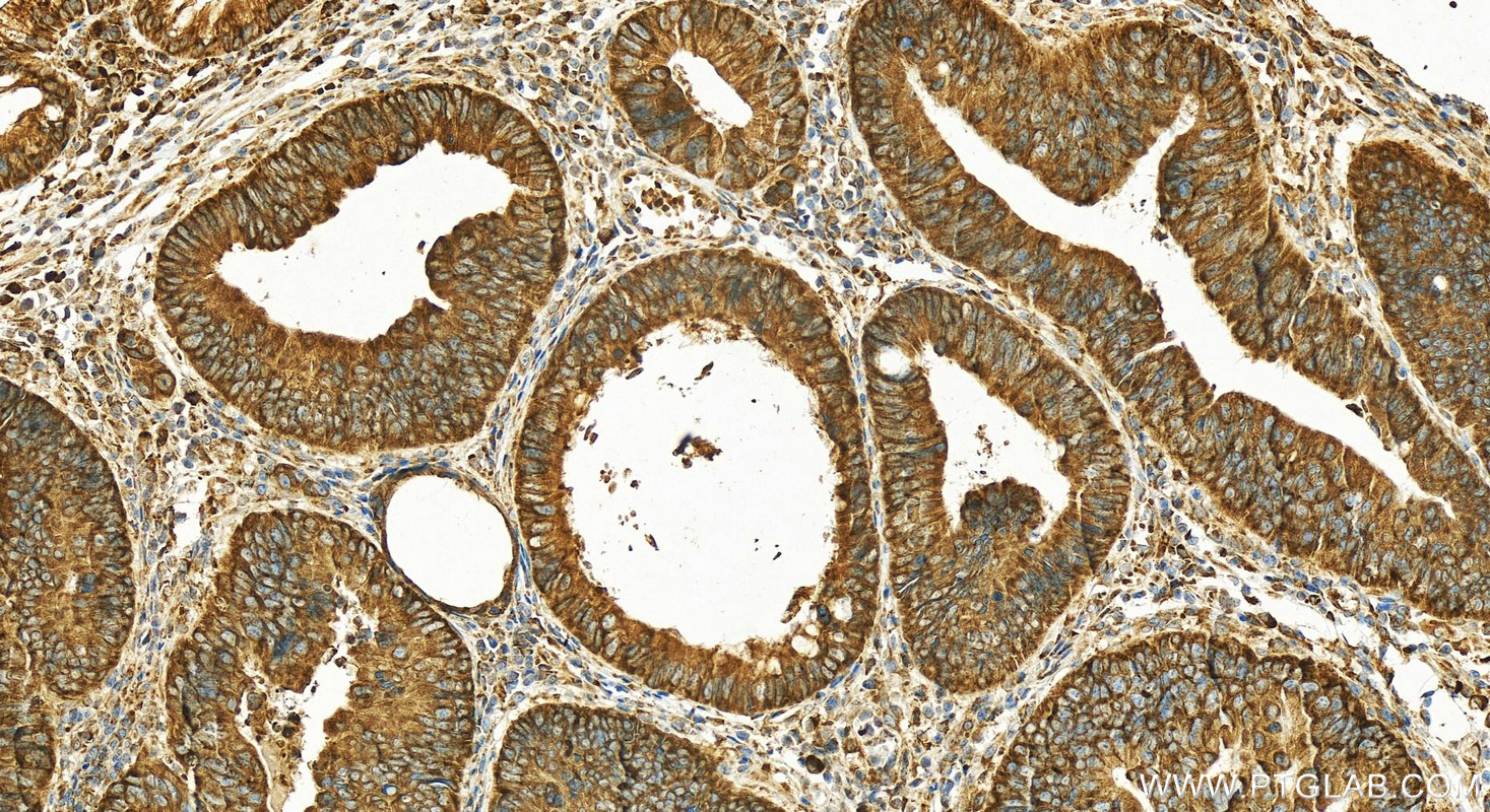 IHC staining of human colon cancer using 17792-1-AP