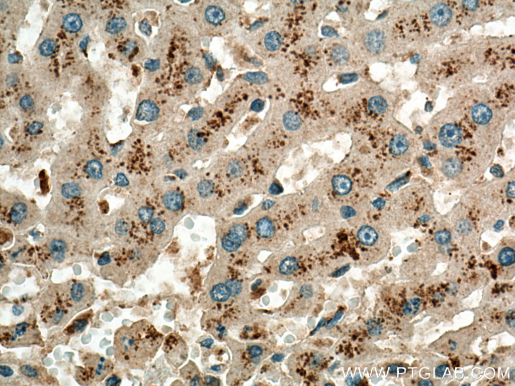 IHC staining of human liver cancer using 13926-1-AP