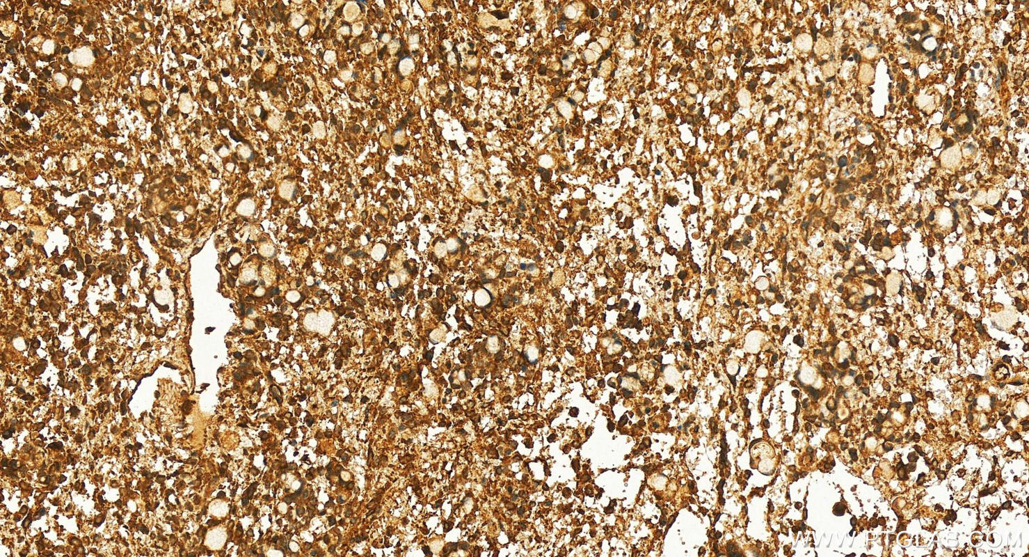 IHC staining of human ovary cancer using 16715-1-AP