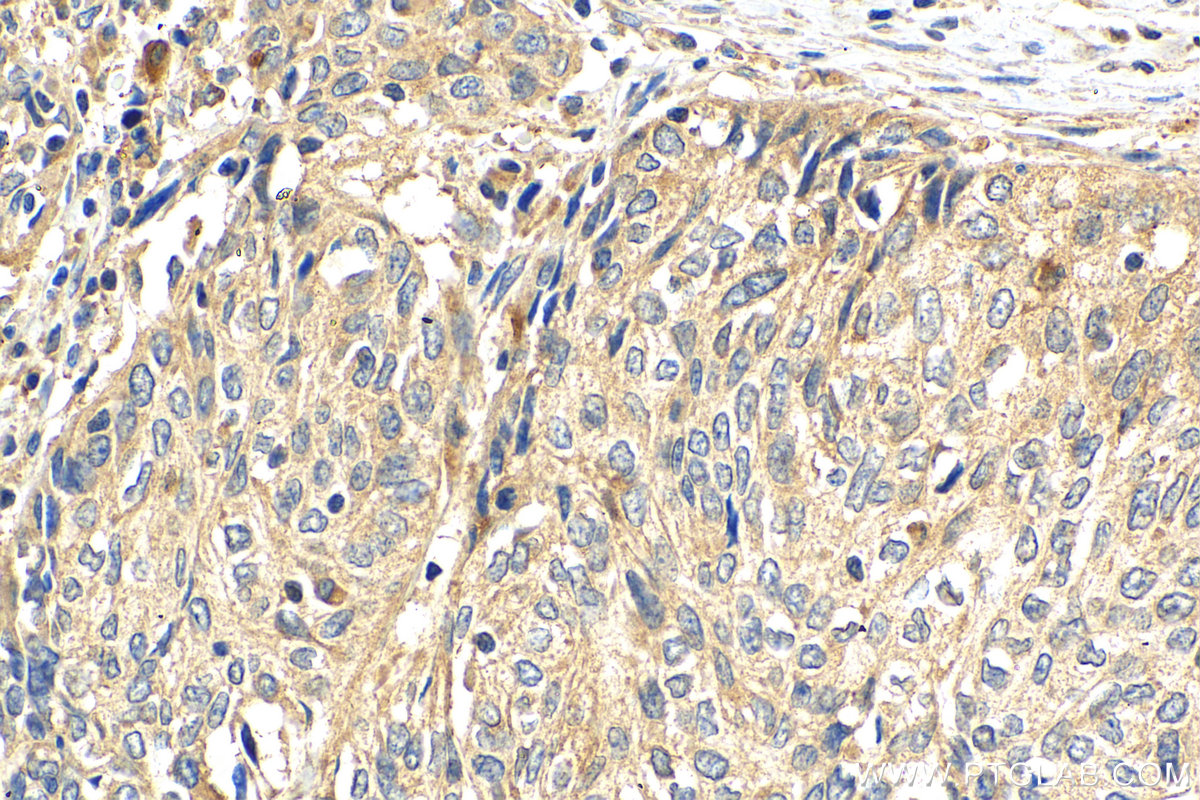 IHC staining of human cervical cancer using 25085-1-AP