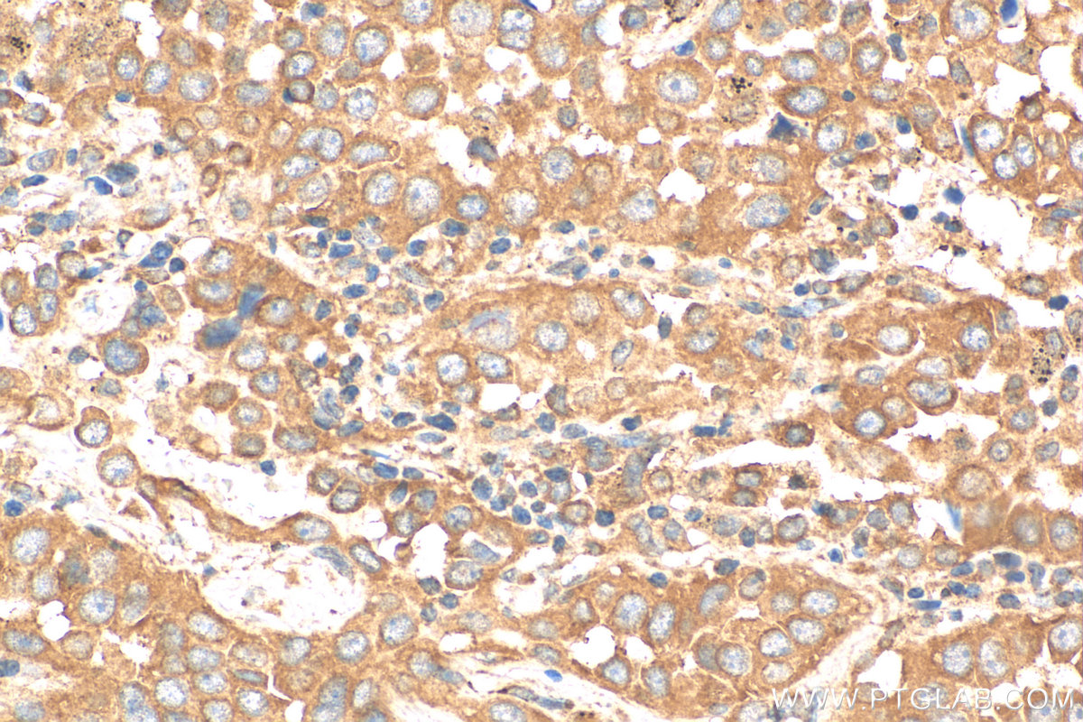 IHC staining of human lung cancer using 14588-1-AP