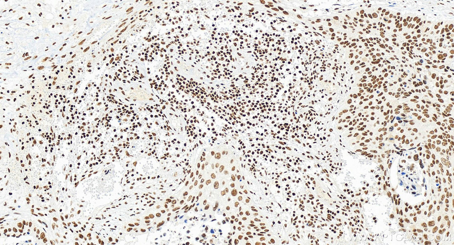 IHC staining of human cervical squamous cancer using 83092-1-RR (same clone as 83092-1-PBS)