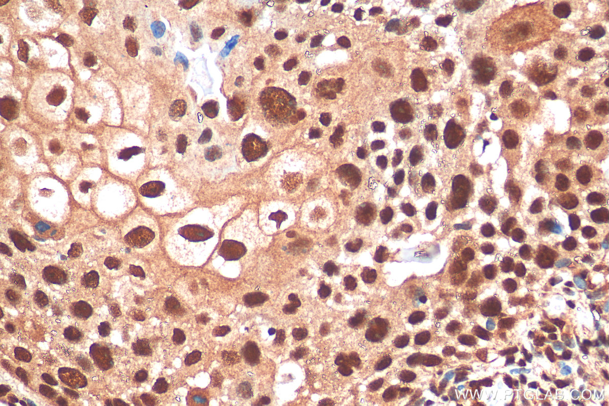 IHC staining of human cervical cancer using 21542-1-AP