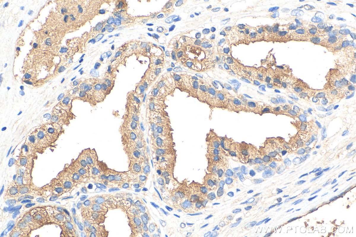 IHC staining of human prostate cancer using 27292-1-AP