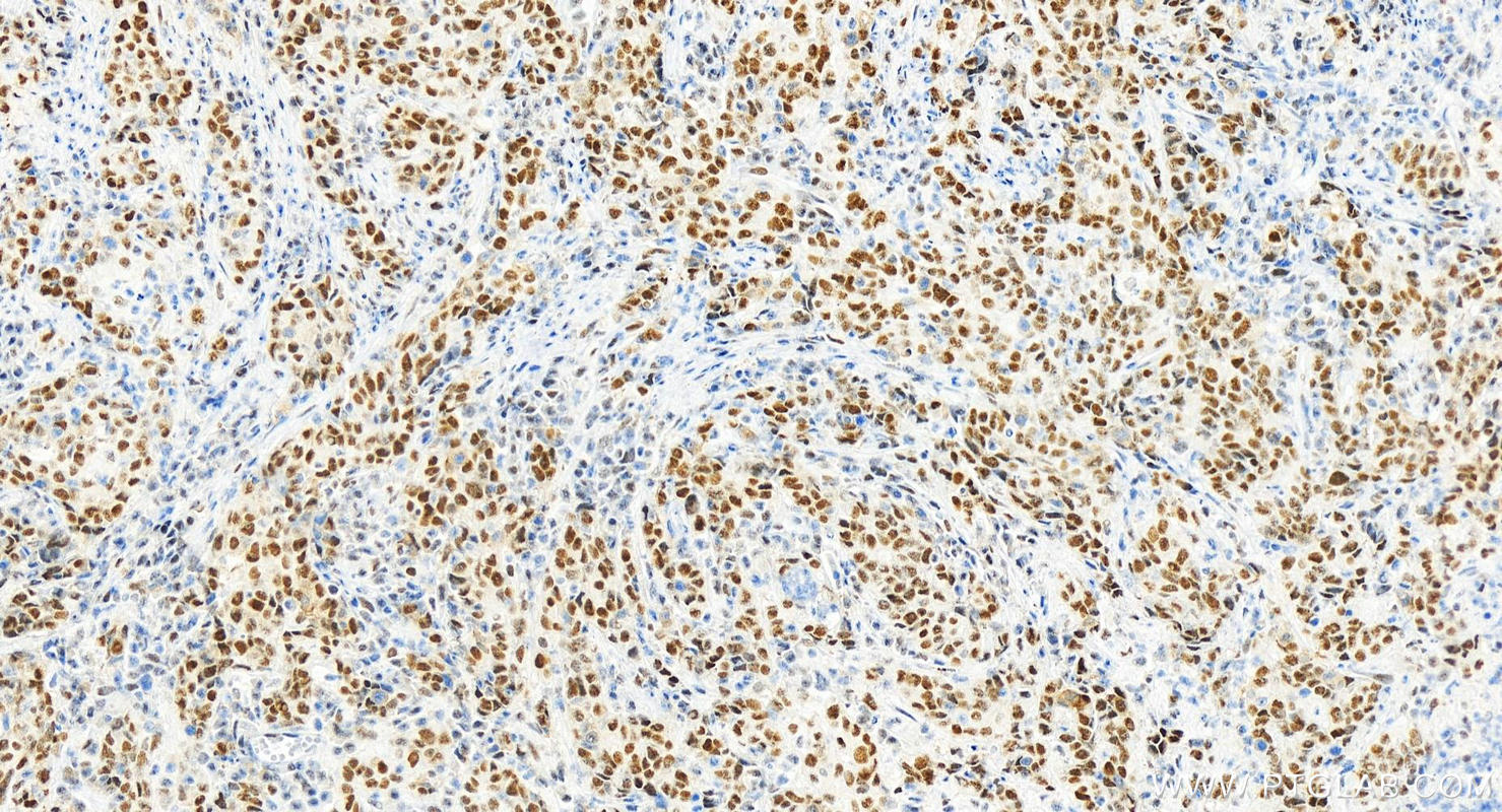 IHC staining of human stomach cancer using 82894-7-RR