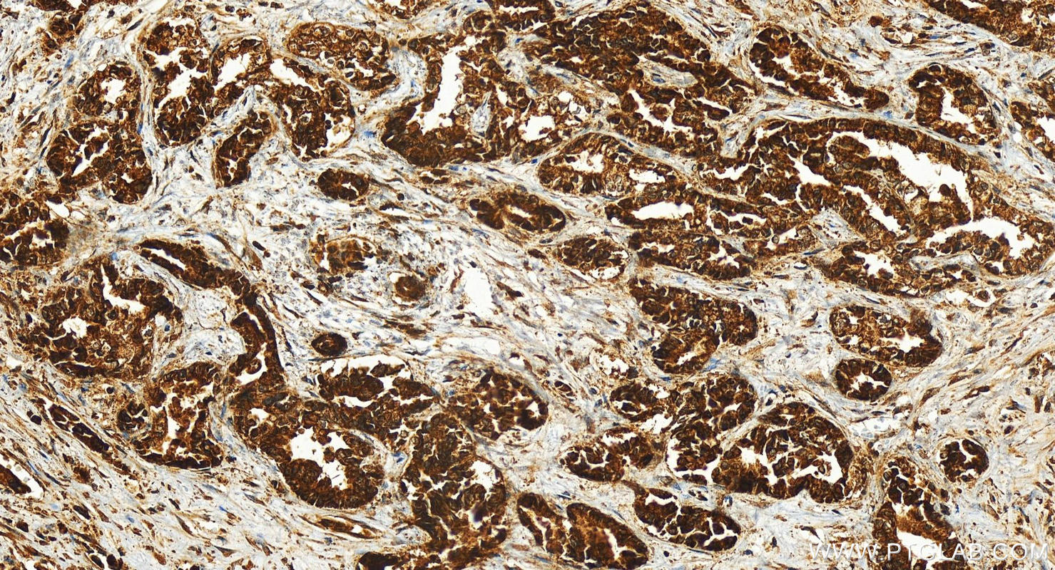 IHC staining of human intrahepatic cholangiocarcinoma using 29786-1-AP