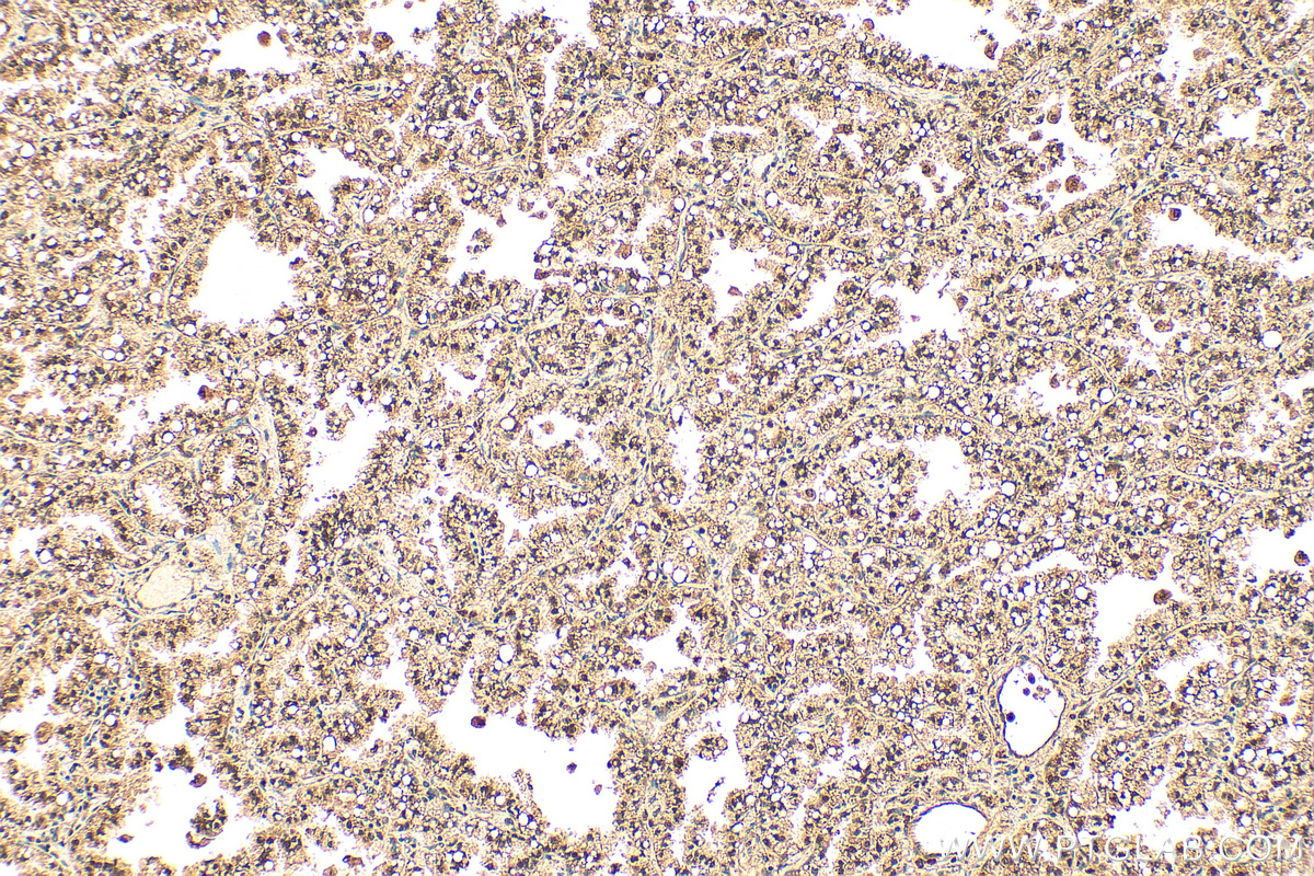 IHC staining of human lung cancer using 24102-1-AP