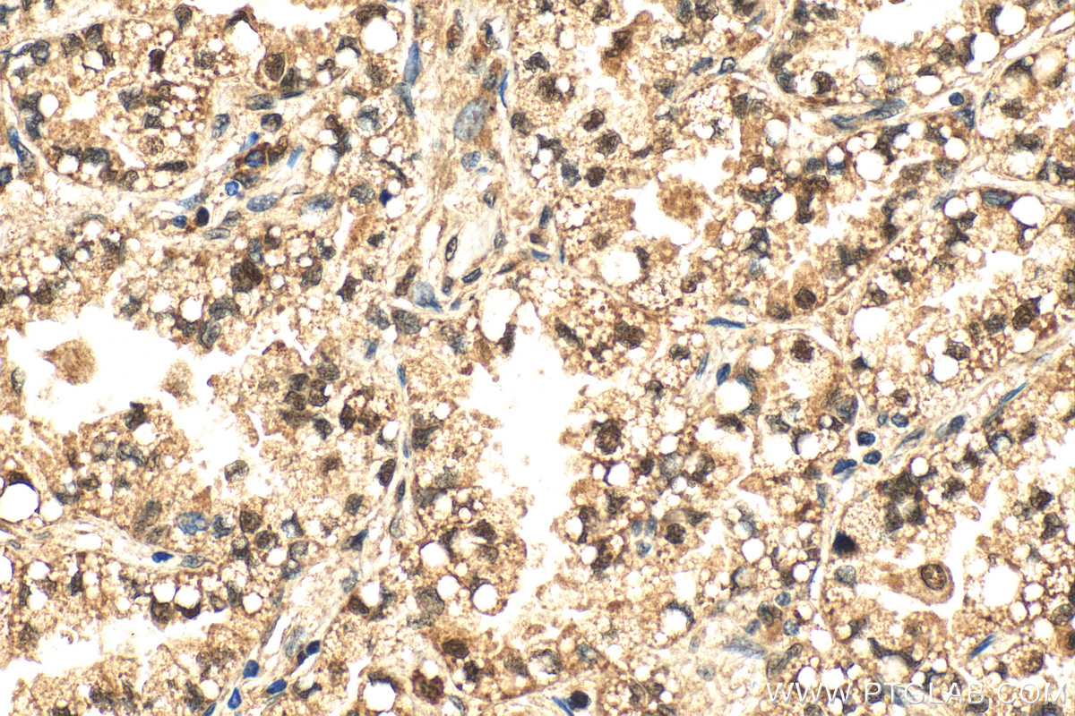 IHC staining of human lung cancer using 24102-1-AP