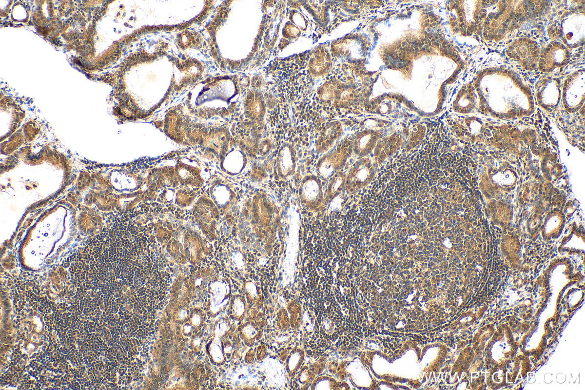 IHC staining of human thyroid cancer using 24102-1-AP