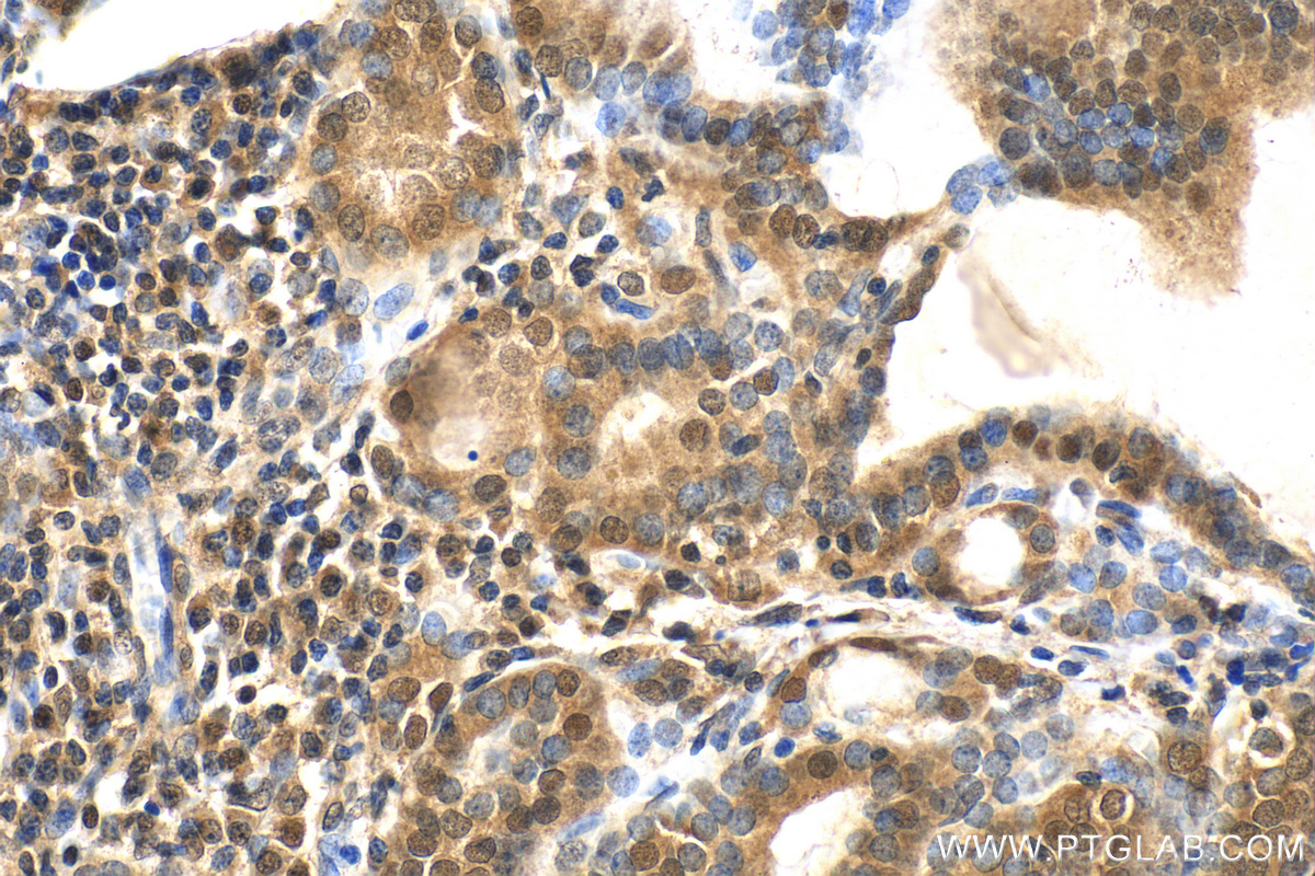 IHC staining of human thyroid cancer using 24102-1-AP