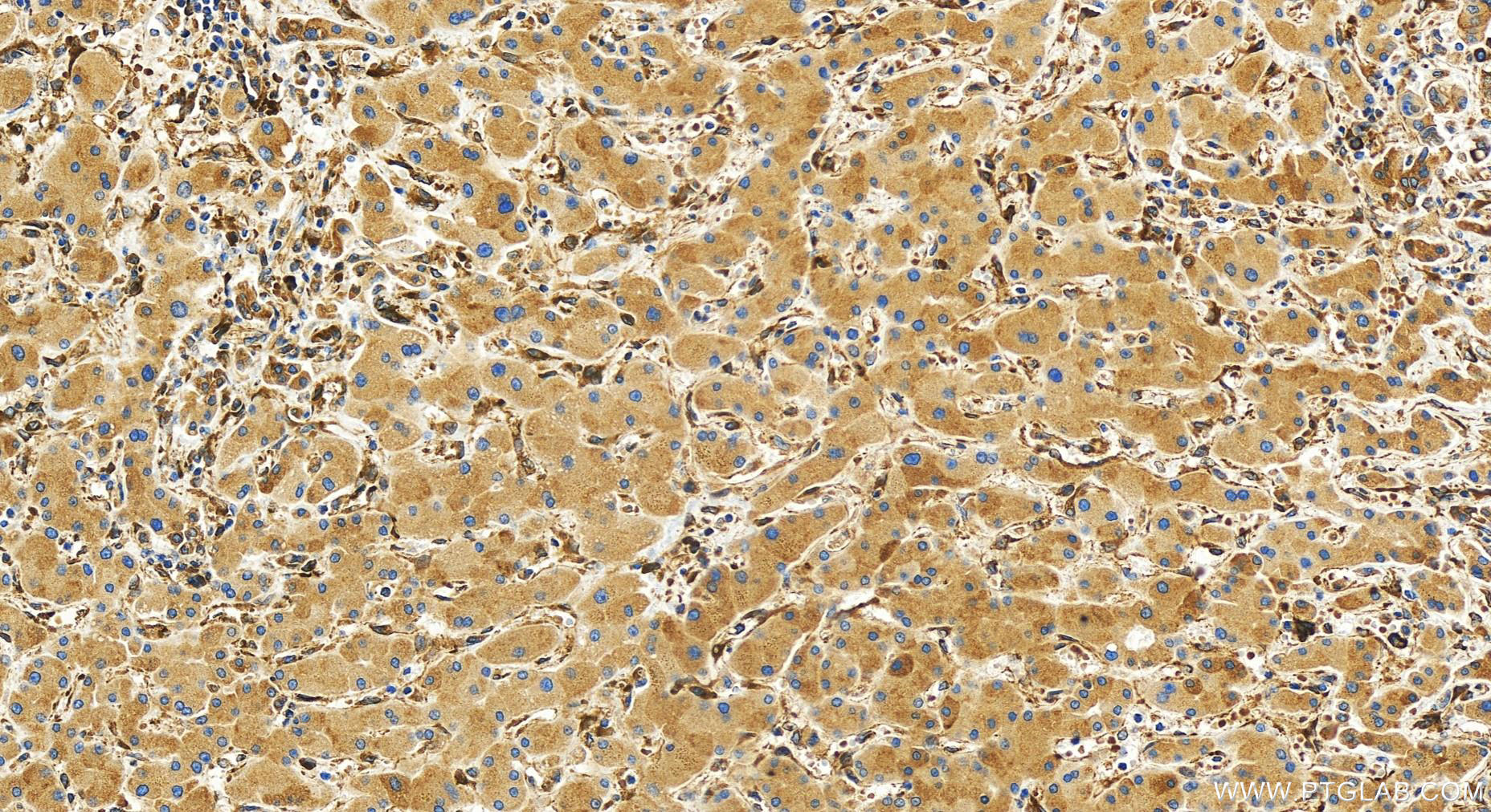 IHC staining of human intrahepatic cholangiocarcinoma using 30604-1-AP