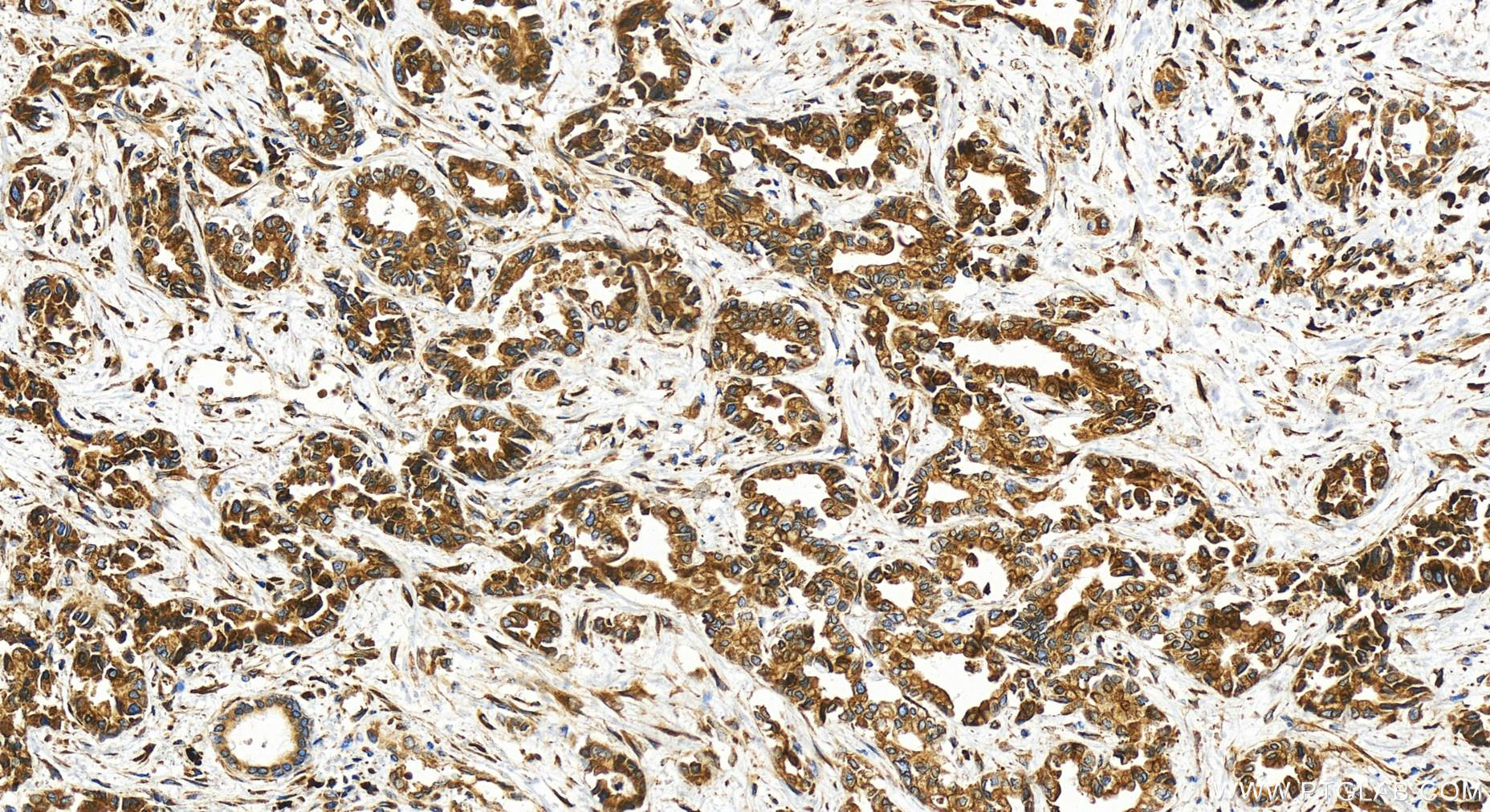 IHC staining of human intrahepatic cholangiocarcinoma using 30604-1-AP