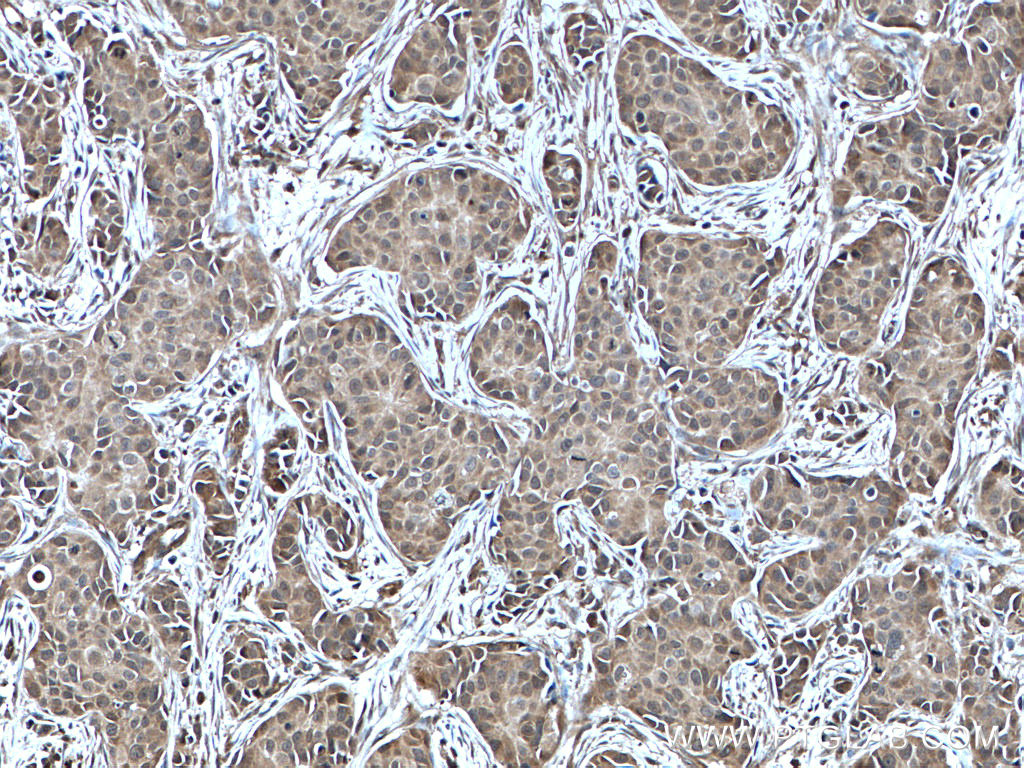 IHC staining of human breast cancer using 10484-1-AP