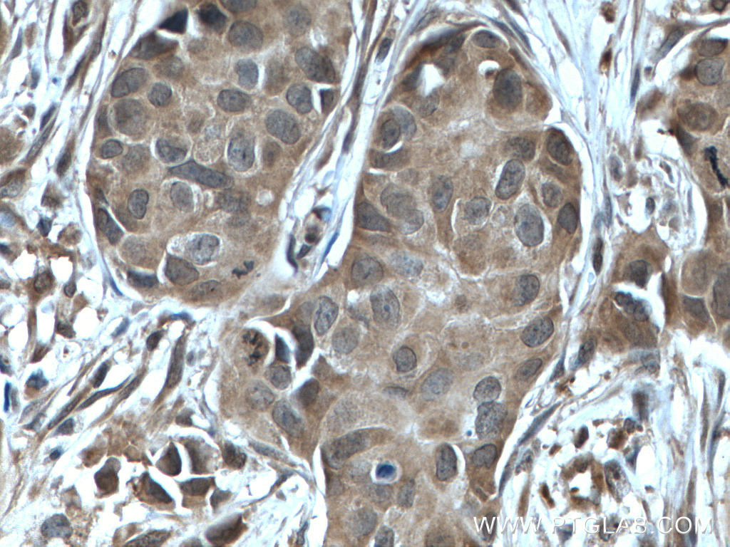 IHC staining of human breast cancer using 10484-1-AP