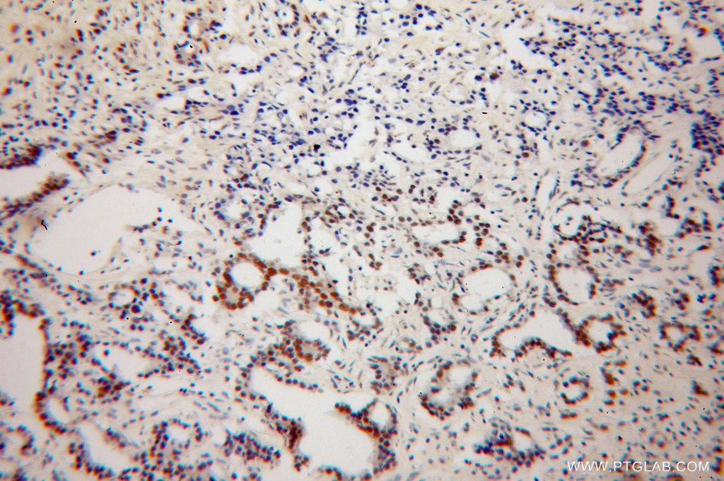 IHC staining of human gliomas using 13275-1-AP