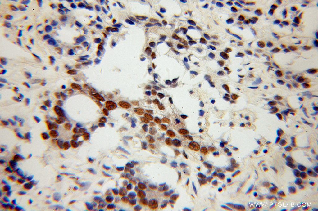 IHC staining of human gliomas using 13275-1-AP