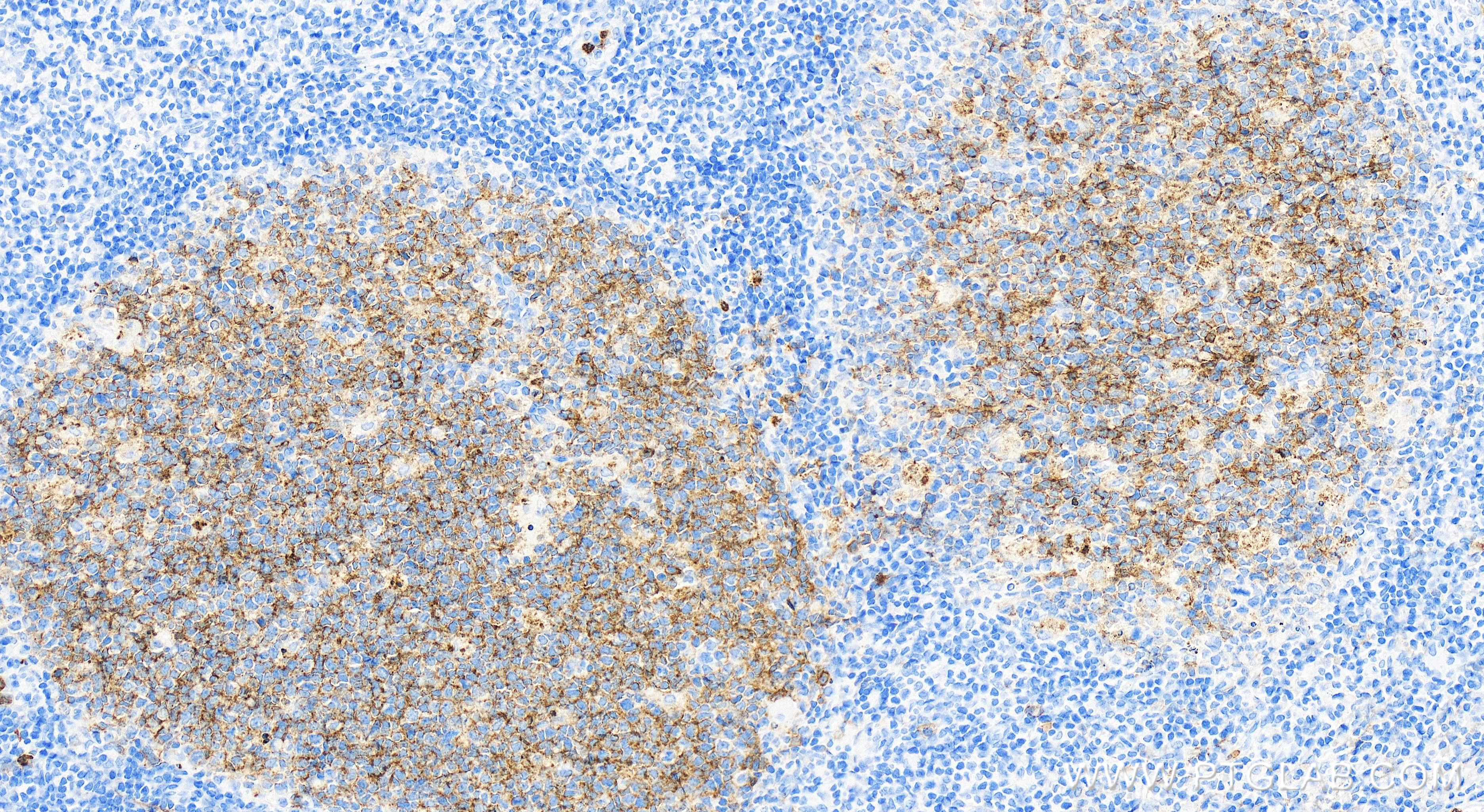 IHC staining of human tonsillitis using 84181-1-RR (same clone as 84181-1-PBS)