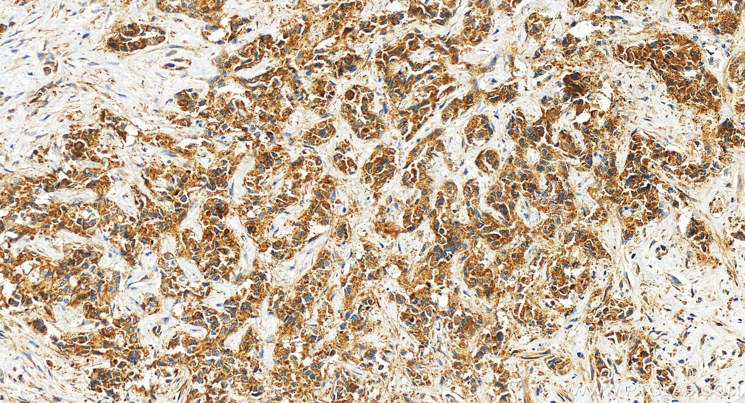 IHC staining of human intrahepatic cholangiocarcinoma using 27193-1-AP