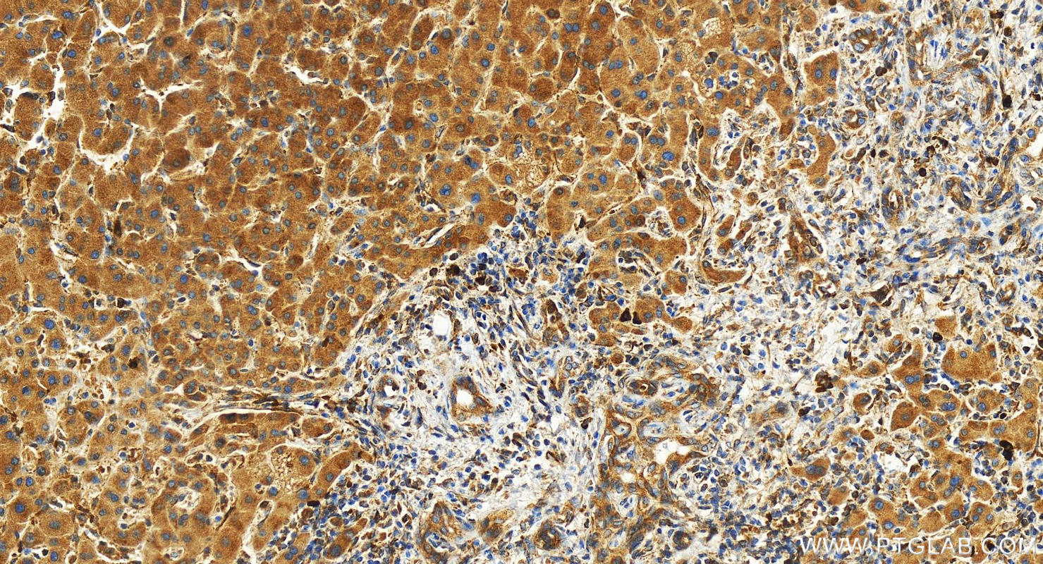 IHC staining of human intrahepatic cholangiocarcinoma using 26712-1-AP