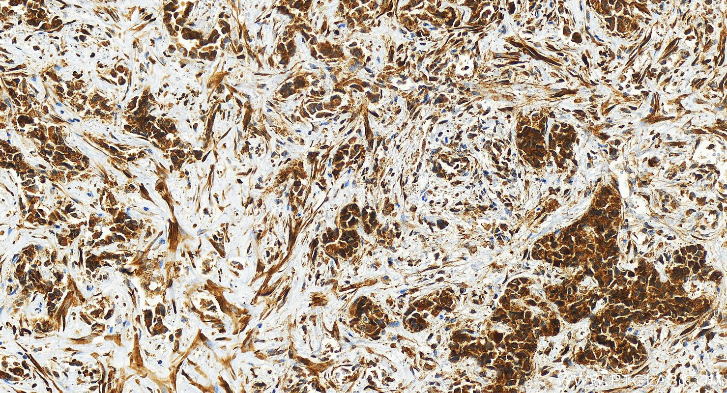 IHC staining of human intrahepatic cholangiocarcinoma using 26712-1-AP