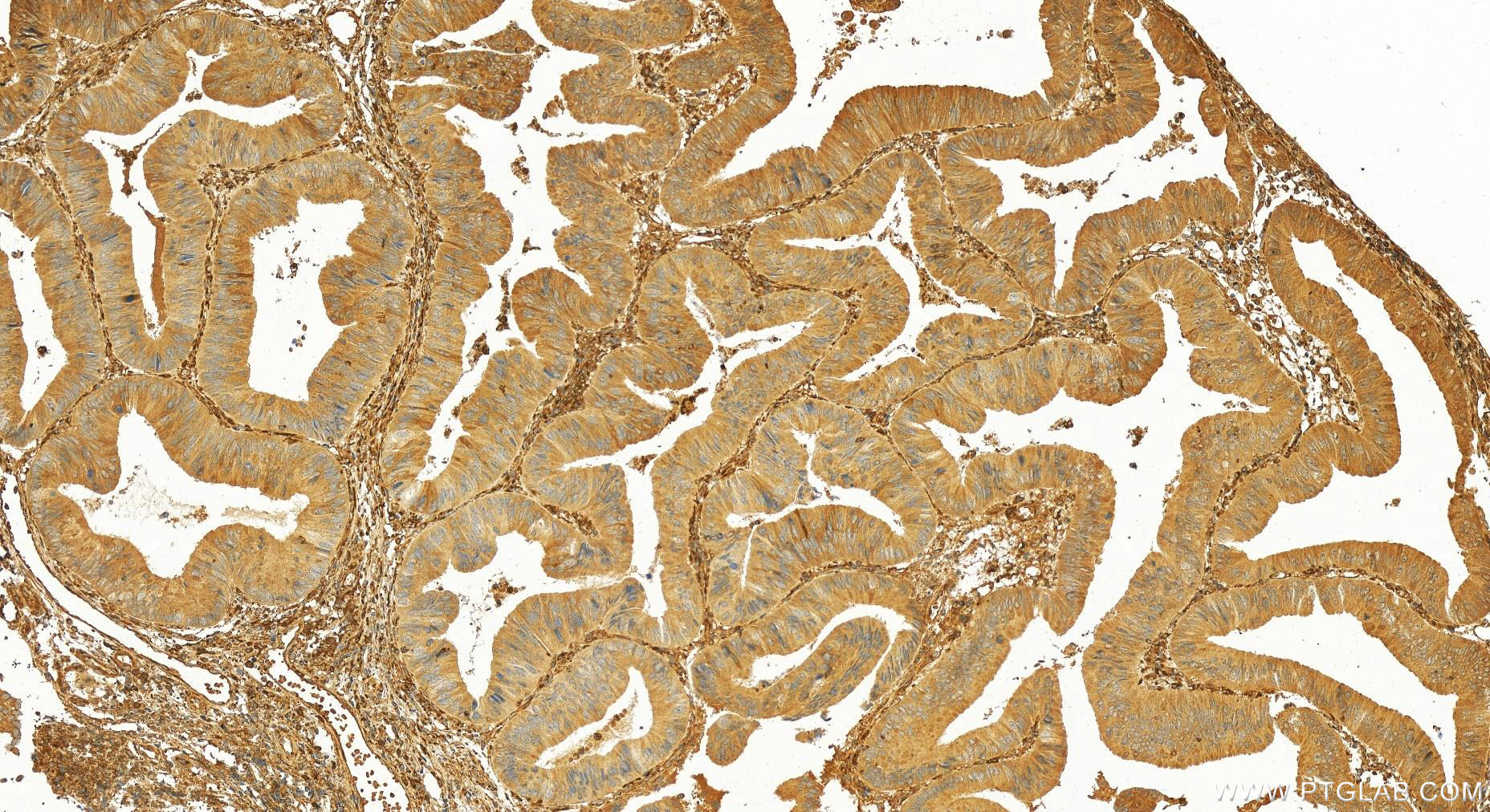 IHC staining of human colon  cancer using 19279-1-AP