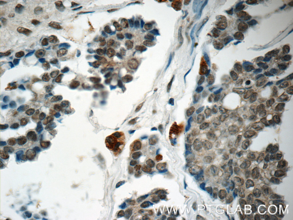 IHC staining of human ovary tumor using 14809-1-AP