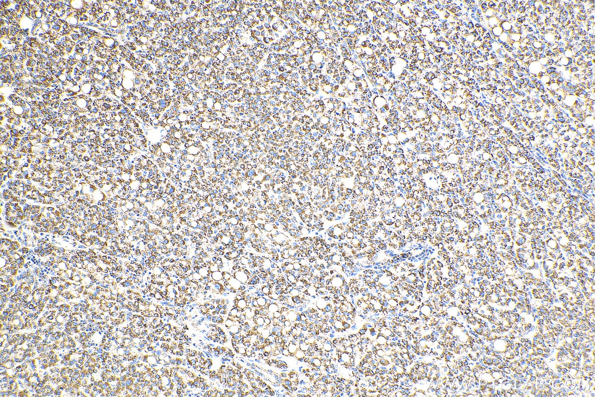 IHC staining of human liver cancer using 16634-1-AP