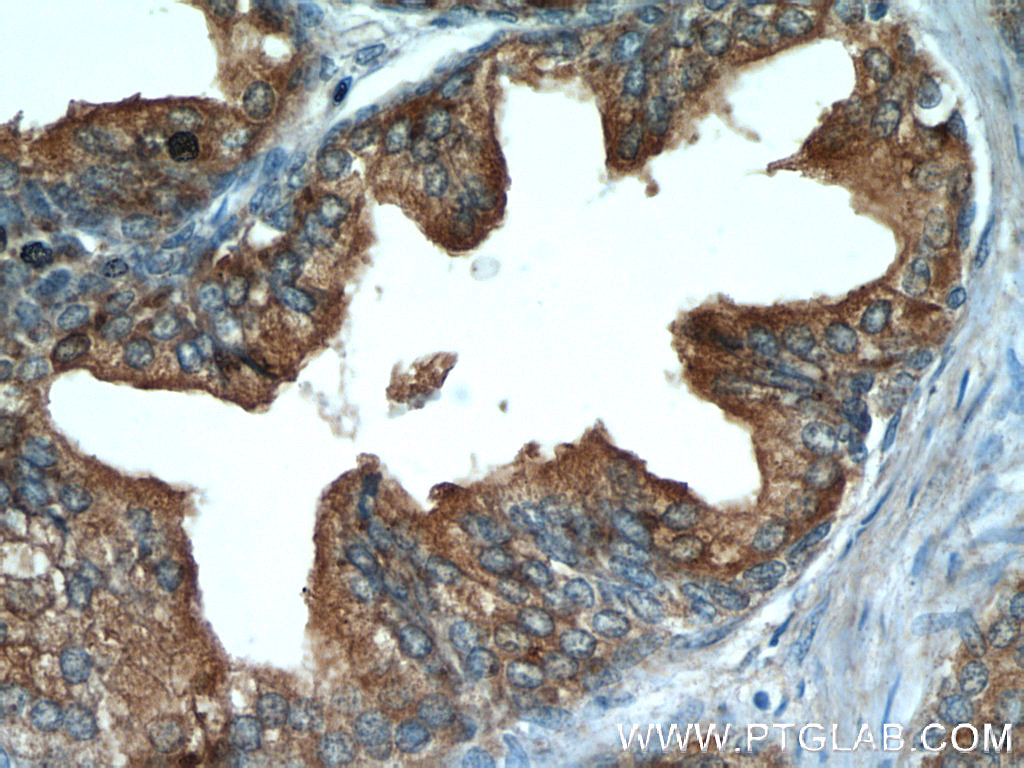 IHC staining of human prostate hyperplasia using 23454-1-AP