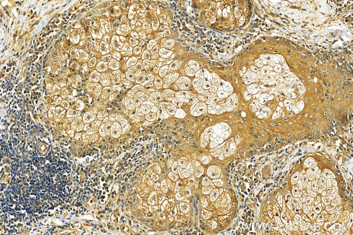 IHC staining of human skin cancer using 28728-1-AP