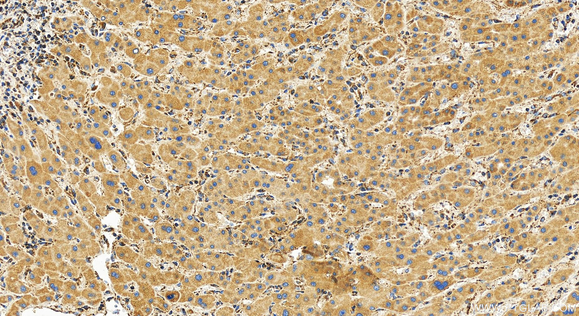 IHC staining of human intrahepatic cholangiocarcinoma using 82773-1-RR