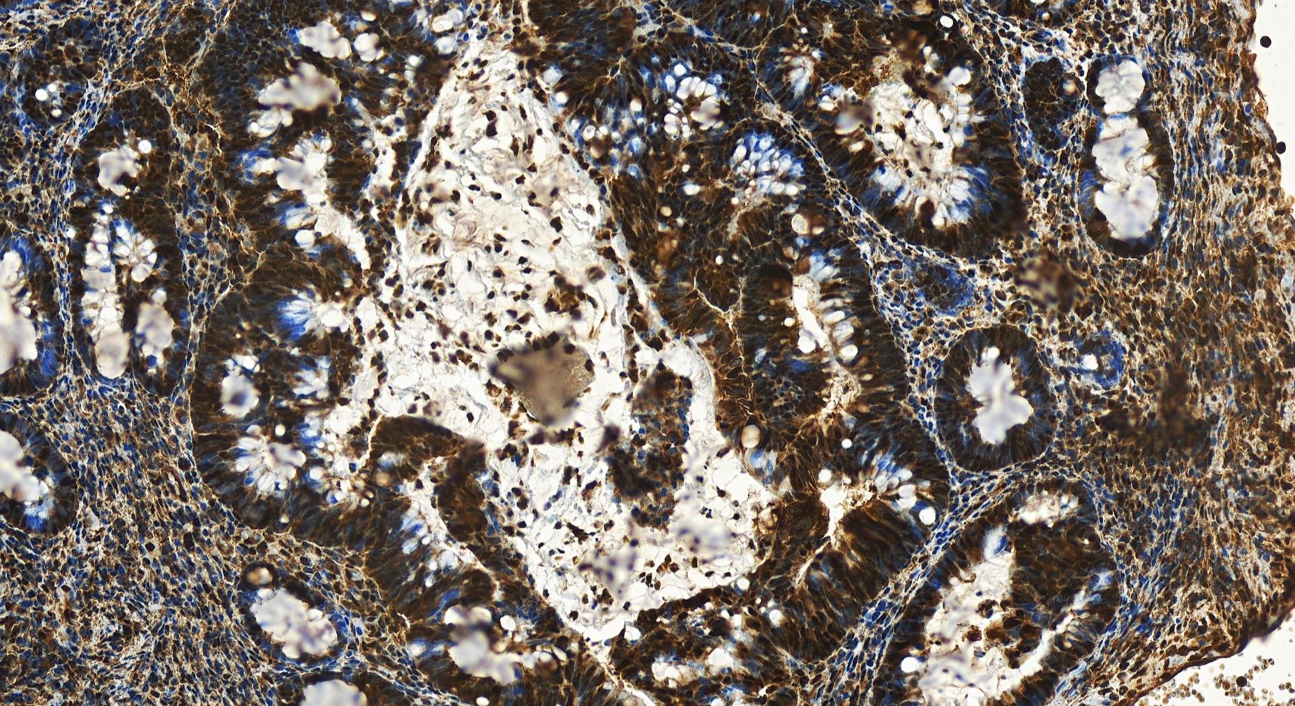 IHC staining of human colon  cancer using 11177-1-AP