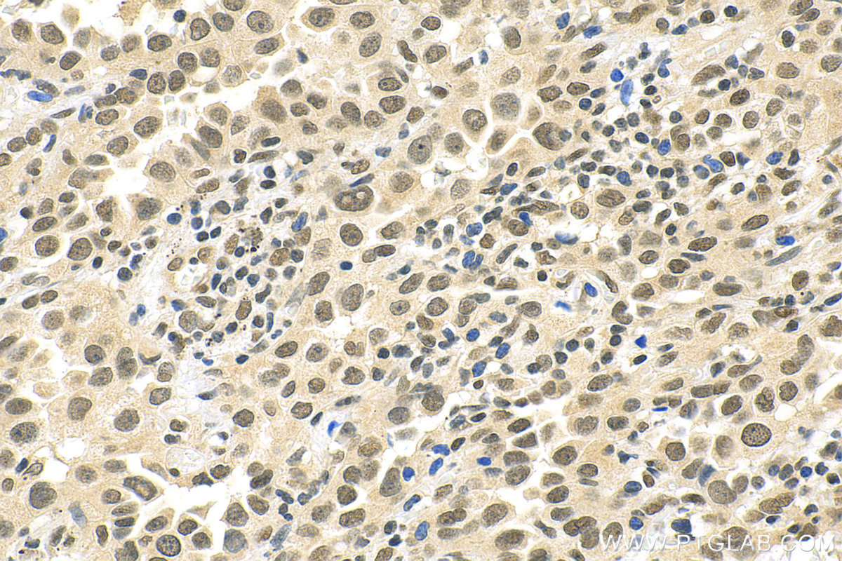 IHC staining of human lung cancer using 11576-2-AP