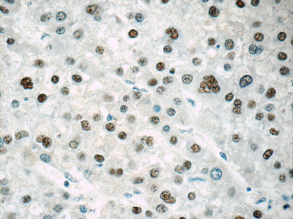 IHC staining of human liver cancer using 25137-1-AP