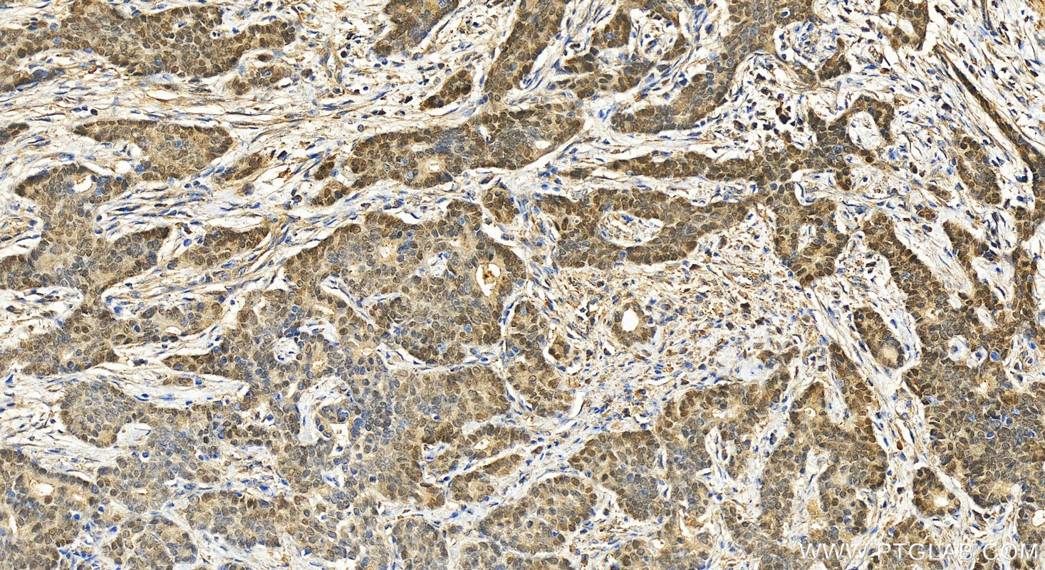 IHC staining of human stomach cancer using 21916-1-AP