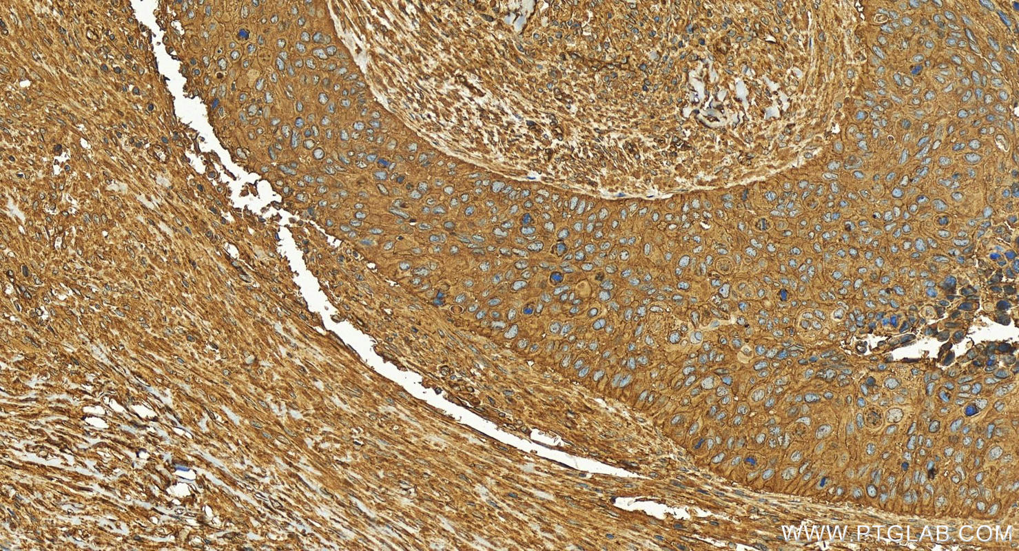 IHC staining of human cervical squamous cancer using 83341-1-RR (same clone as 83341-1-PBS)