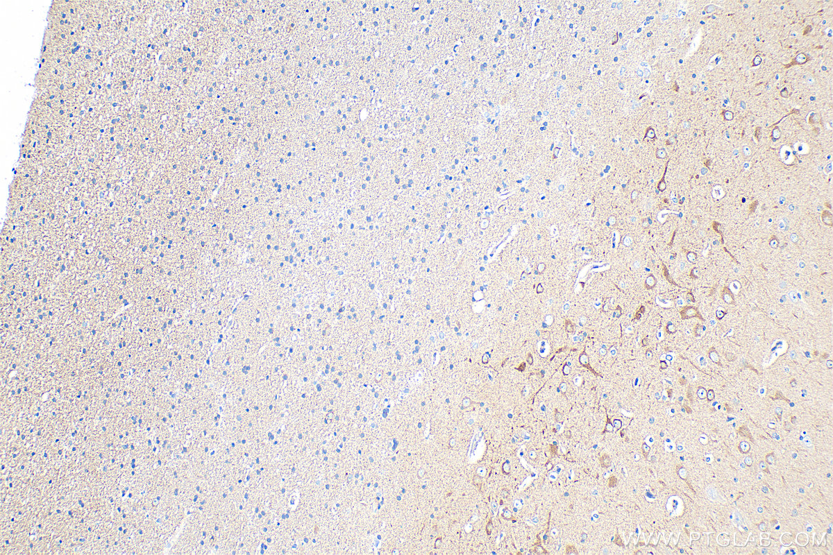 IHC staining of human gliomas using 83634-5-RR (same clone as 83634-5-PBS)