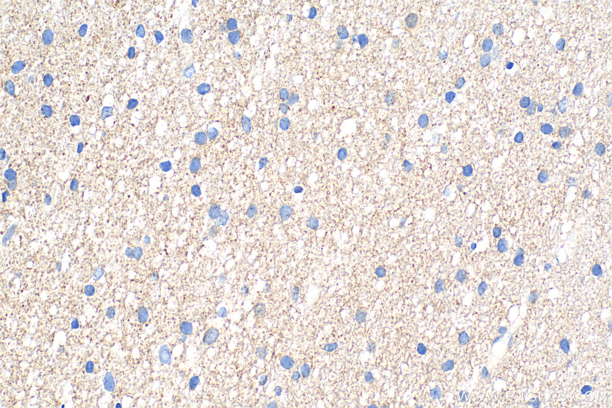 IHC staining of human gliomas using 83634-5-RR (same clone as 83634-5-PBS)