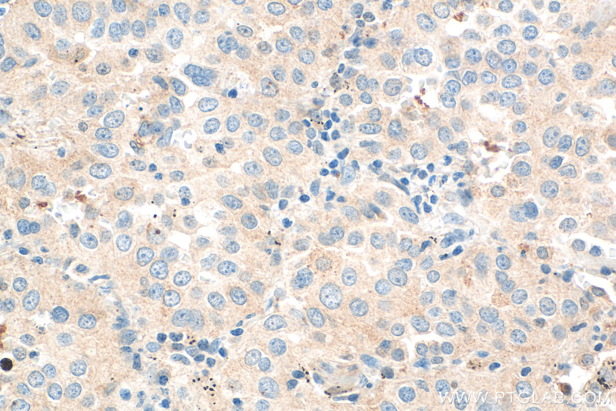 IHC staining of human lung cancer using 26954-1-AP