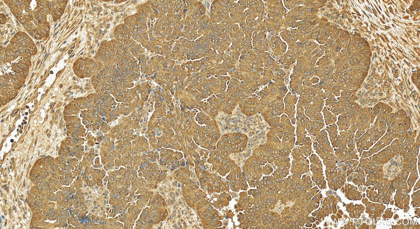 IHC staining of human ovary cancer using 14751-1-AP