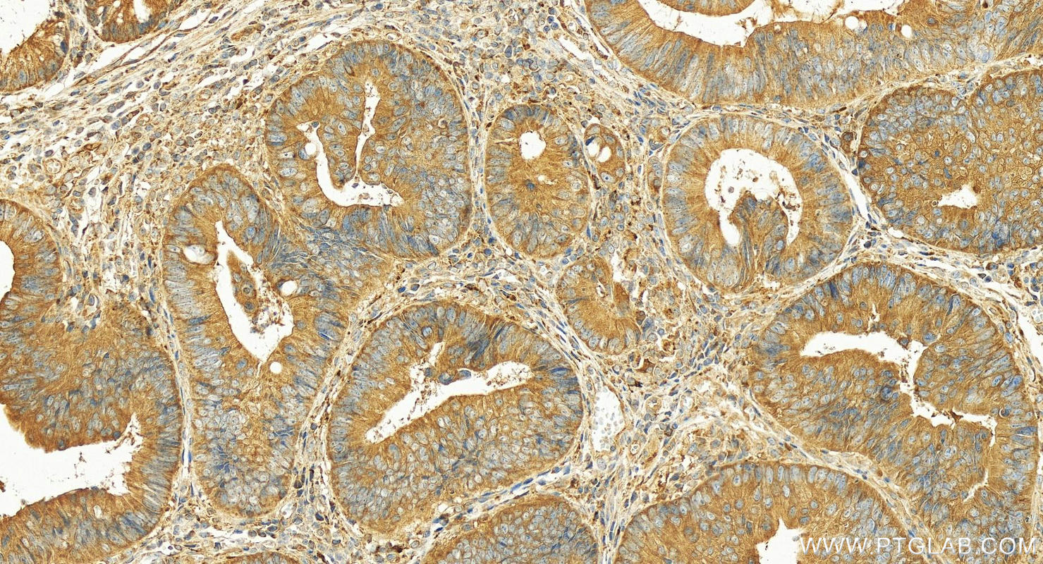 IHC staining of human colon cancer using 12417-1-AP