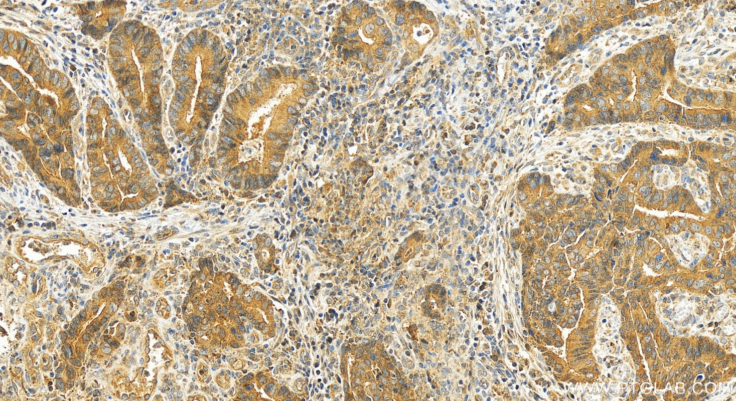 IHC staining of human colon cancer using 27792-1-AP