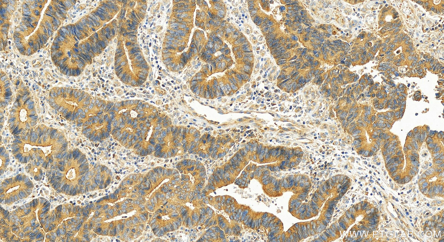 IHC staining of human colon cancer using 27792-1-AP