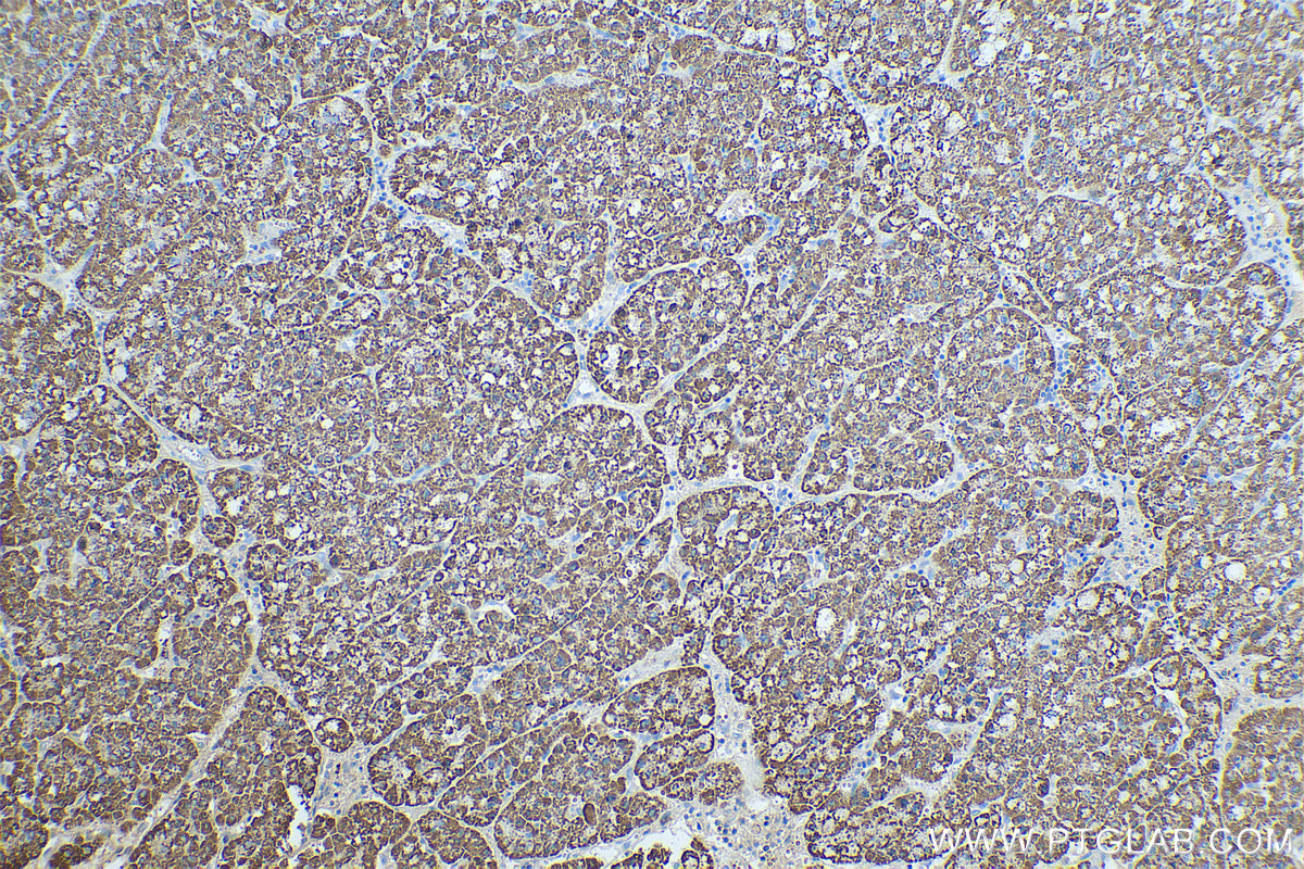 IHC staining of human liver cancer using 67553-1-Ig (same clone as 67553-1-PBS)
