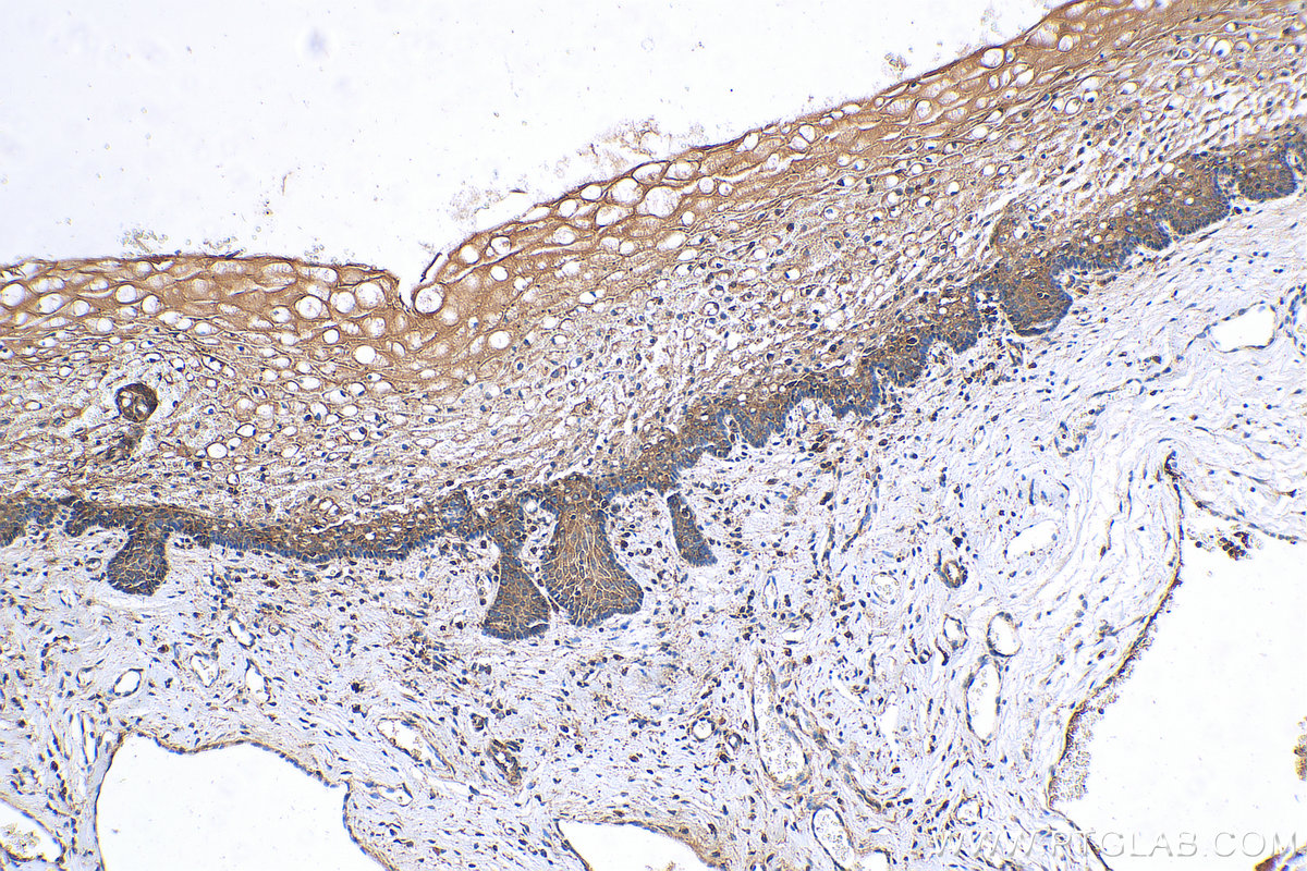 IHC staining of human cervical cancer using 29921-1-AP