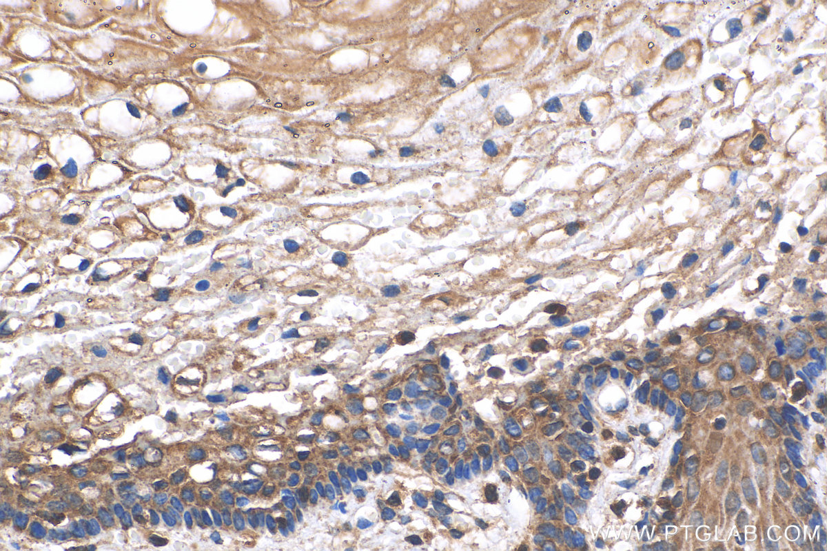 IHC staining of human cervical cancer using 29921-1-AP