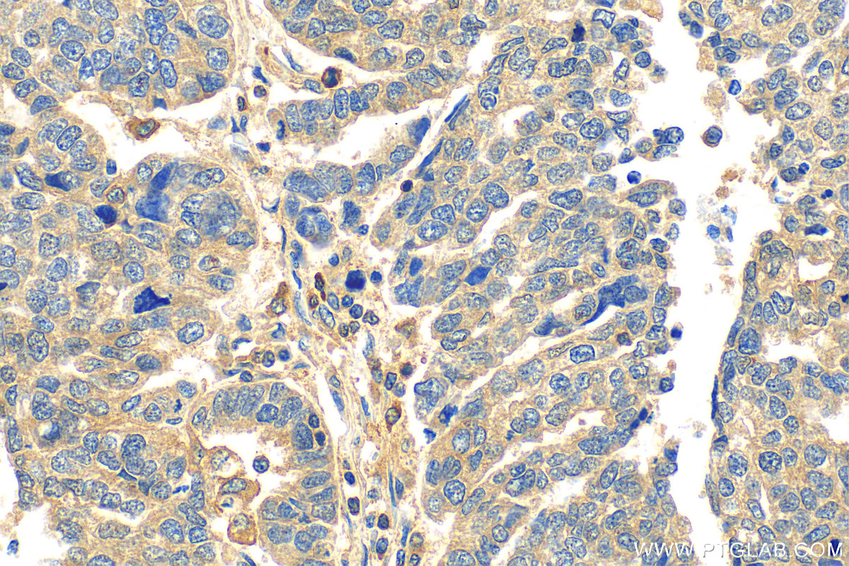 IHC staining of human ovary tumor using 29921-1-AP