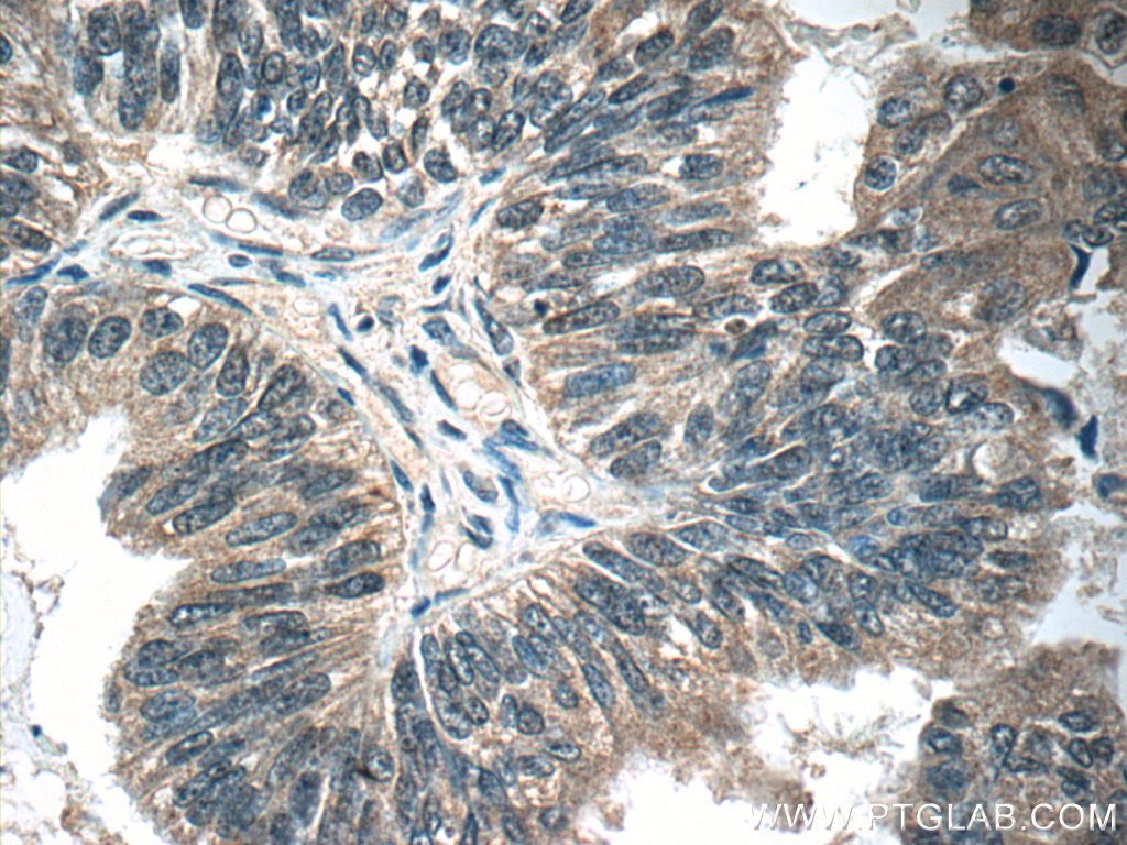 IHC staining of human ovary tumor using 25430-1-AP